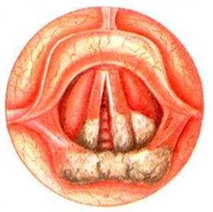 Дифтерия на гортани