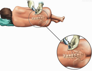 Процесс введения иглы при эпидуральной анастезии