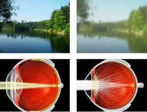 Влияние катаракты на зрение