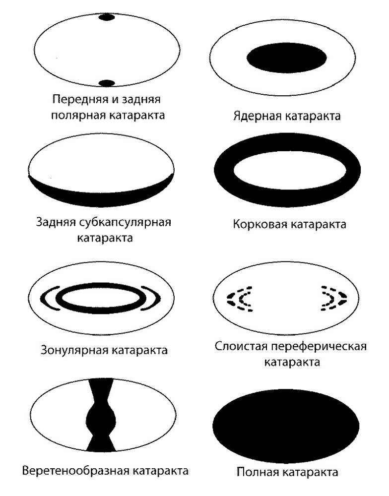 Катаракта схема