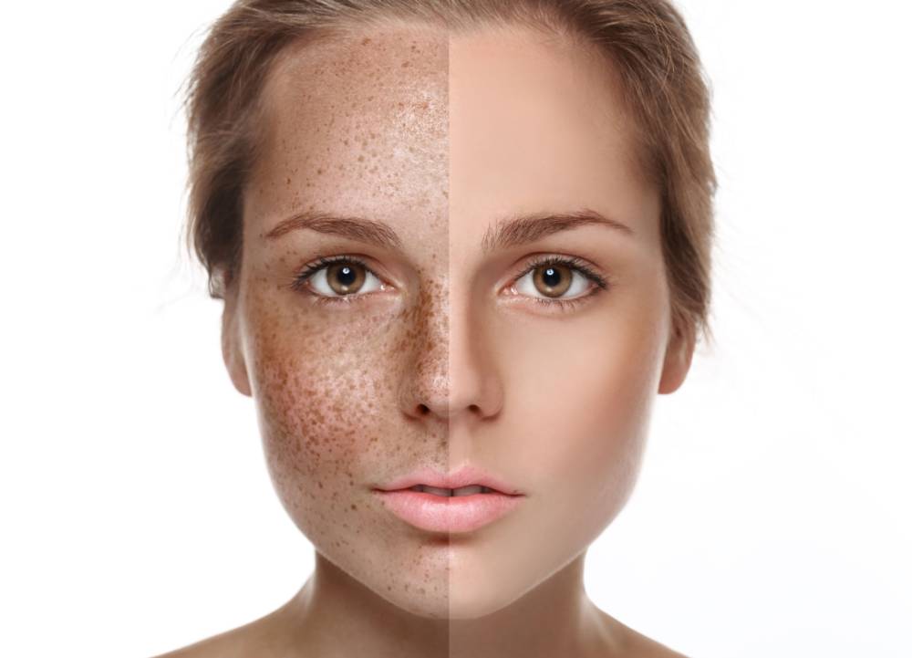 Проблемная кожа. Причины обесцвечивания