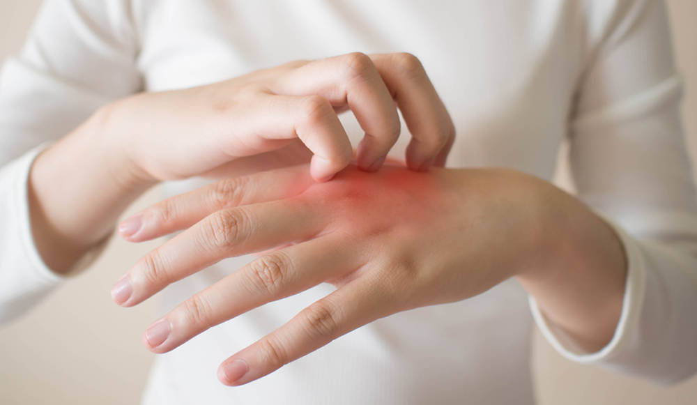 Что нужно знать об экземе и пищевой аллергии