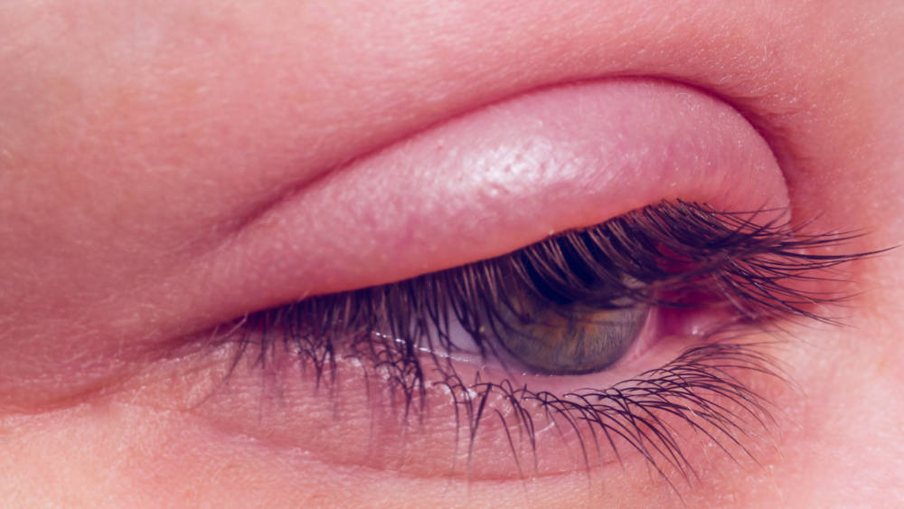 Что такое блефарит?