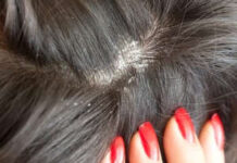 Перхоть — причины и советы по лечению недуга