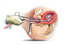 Как делают вакуум аборт (мини-аборт) — насколько опасна данная операция