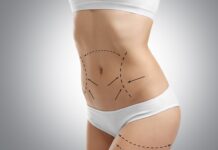 Что нужно знать до операции по абдоминопластике?