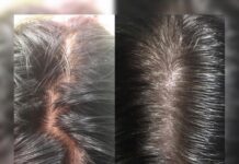 Мезотерапия волос с препаратом Mesoline Нair 5 ml