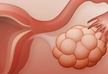 Синдром поликистозных яичников – все более распространенная проблема молодых женщин