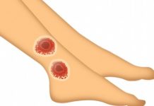 Трофические язвы – последствия нелеченного варикоза