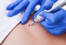 Как удалить бородавку за один день: современные и народные способы