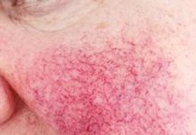 Unlocking the Splendor of IPL Laser in the UK: The Ultimate Guide