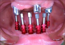 Стоматологические слепочные трансферы: суть и применение