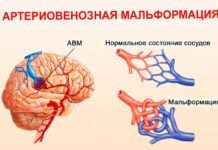 Артерио-венозная мальформация (АВМ) — лечение в центре «Гамма-нож»